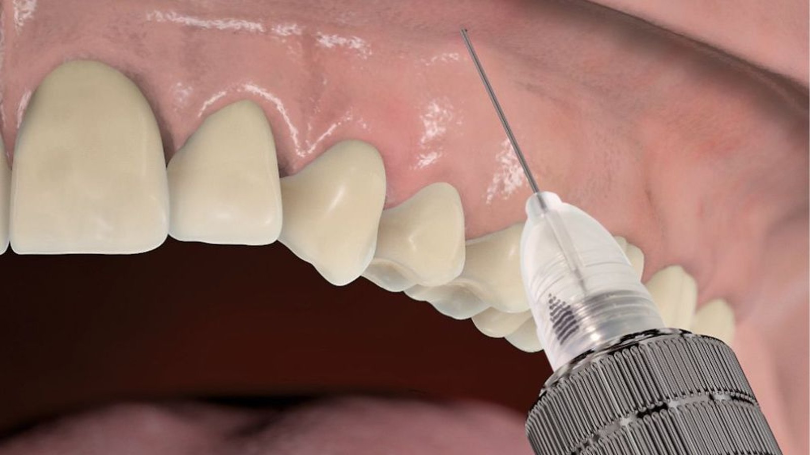 seringue anesthésie dentaire