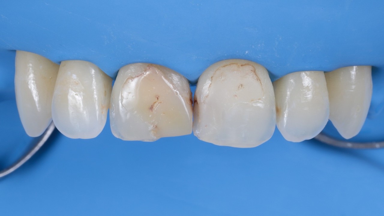 Isolation du champs opératoire