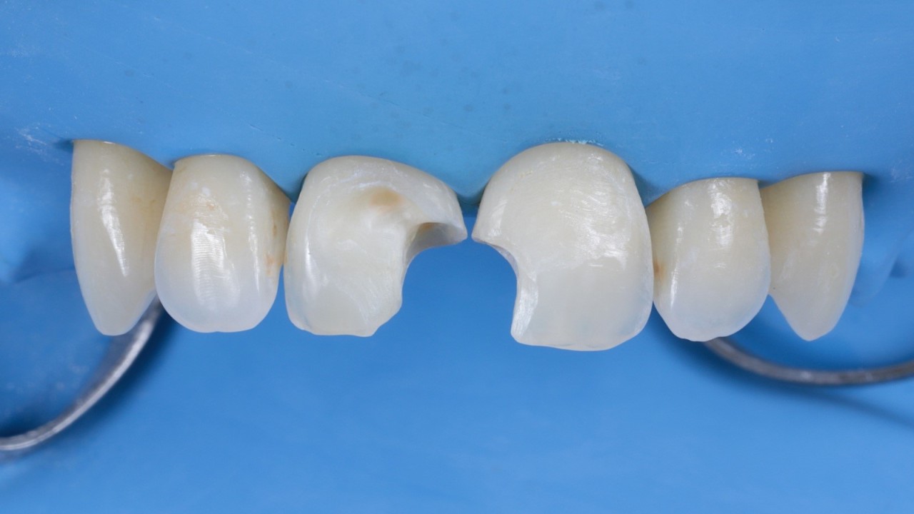 Élimination de l'ancien composite et des tissus cariés