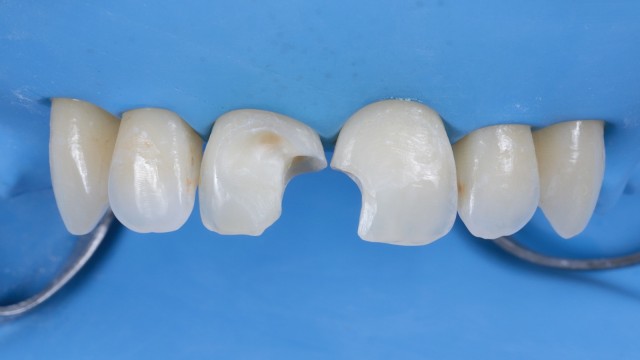 Étape 3 : Élimination de l'ancien composite et des tissus cariés 