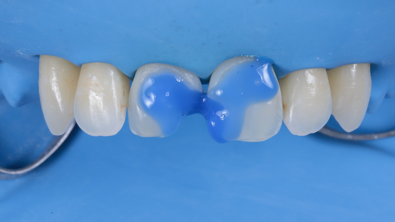 Mordançage et adhésion