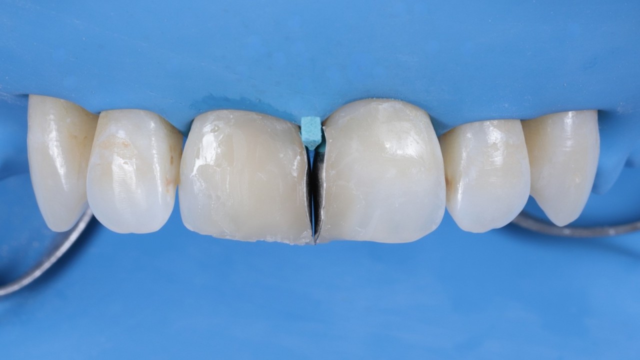  Reconstruction avec Venus Pearl Pure Shades