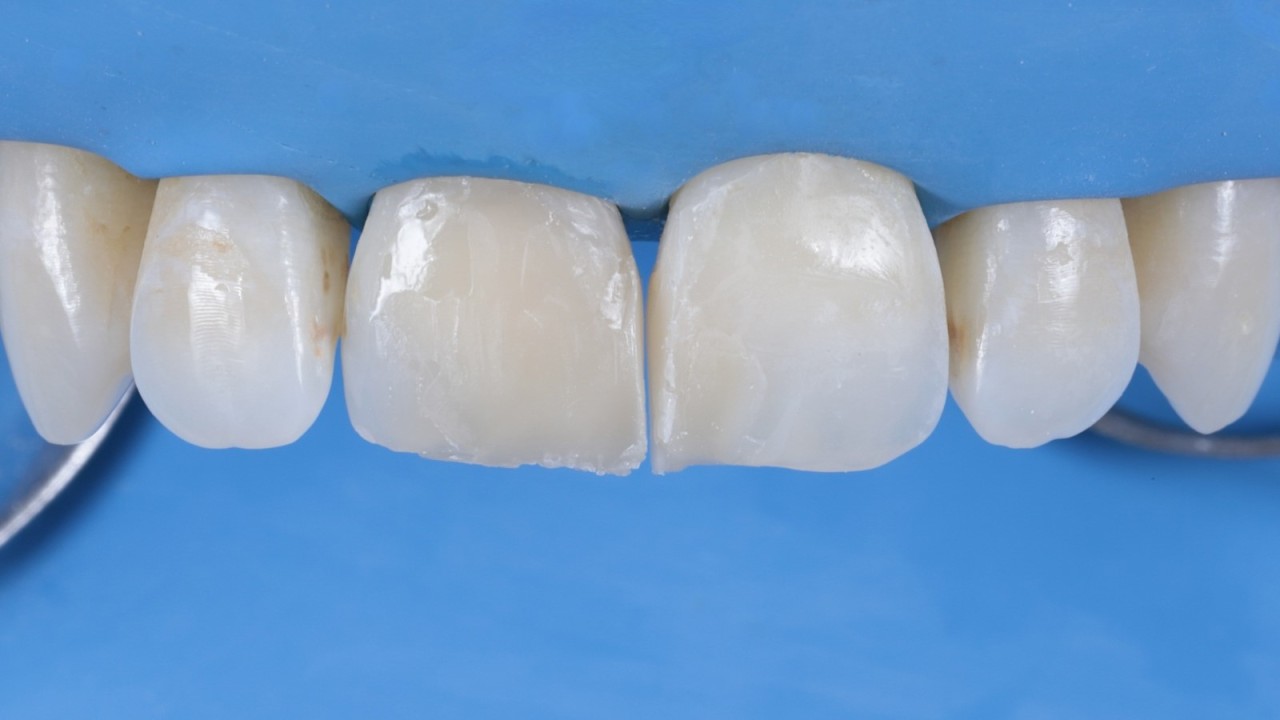 Restaurations avant finition et polissage