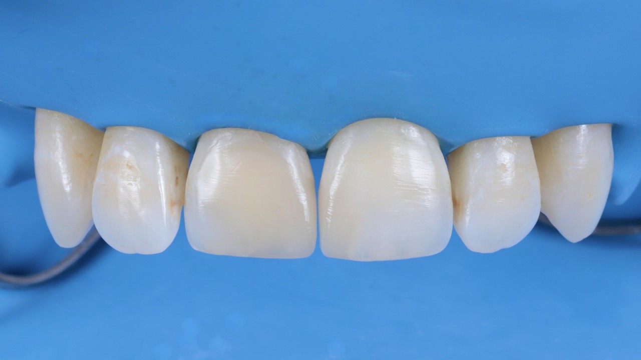 Restaurations directement après le polissage