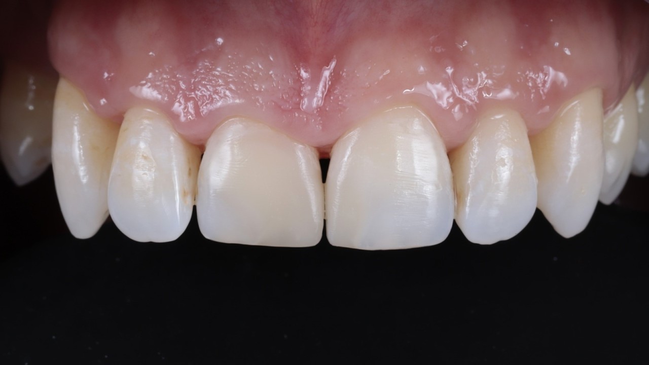 Résultat final après réhydratation