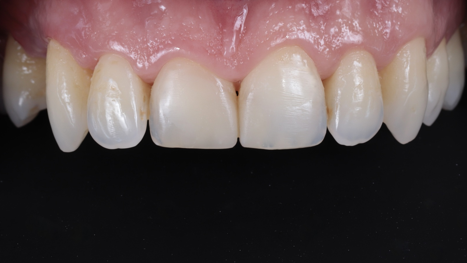 Un cas clinique avec Venus Pearl Pure Shades par le Dr Riccardo Baratto 