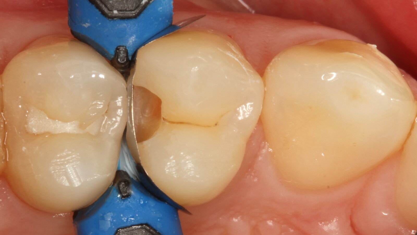 Matrice de section in situ.
