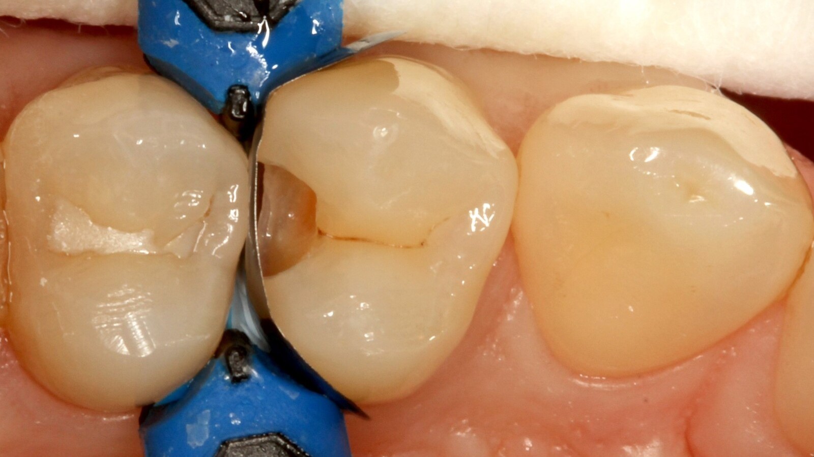 Cavité scellée à l'aide d'un adhésif.