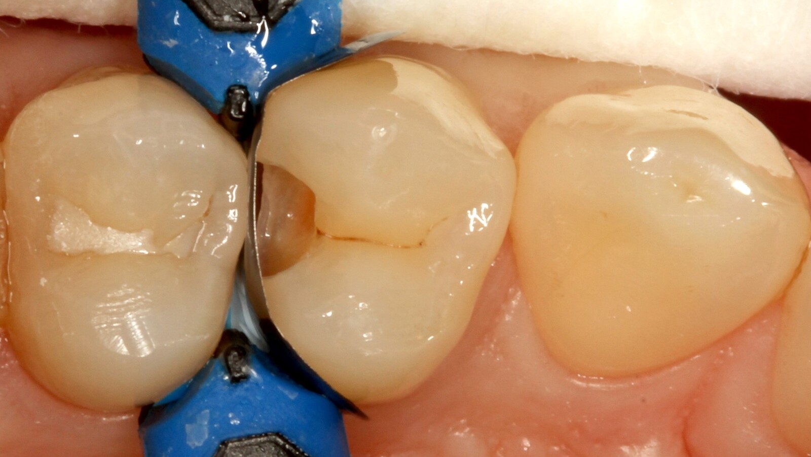Cavité scellée à l'aide d'un adhésif.
