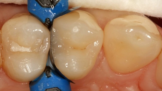 Cavité remplie avec Venus Bulk Flow ONE en une seule couche.