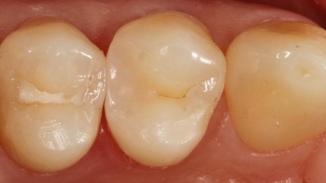 Restauration Venus Bulk Flow ONE finie et polie.