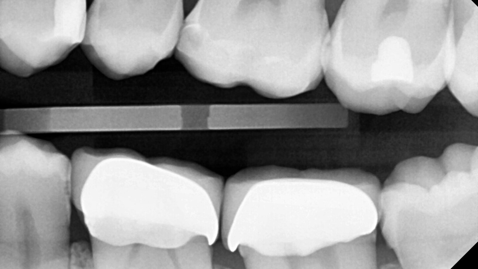  Contrôle radiographique : Très bonne radio-opacité de Venus Bulk Flow ONE
