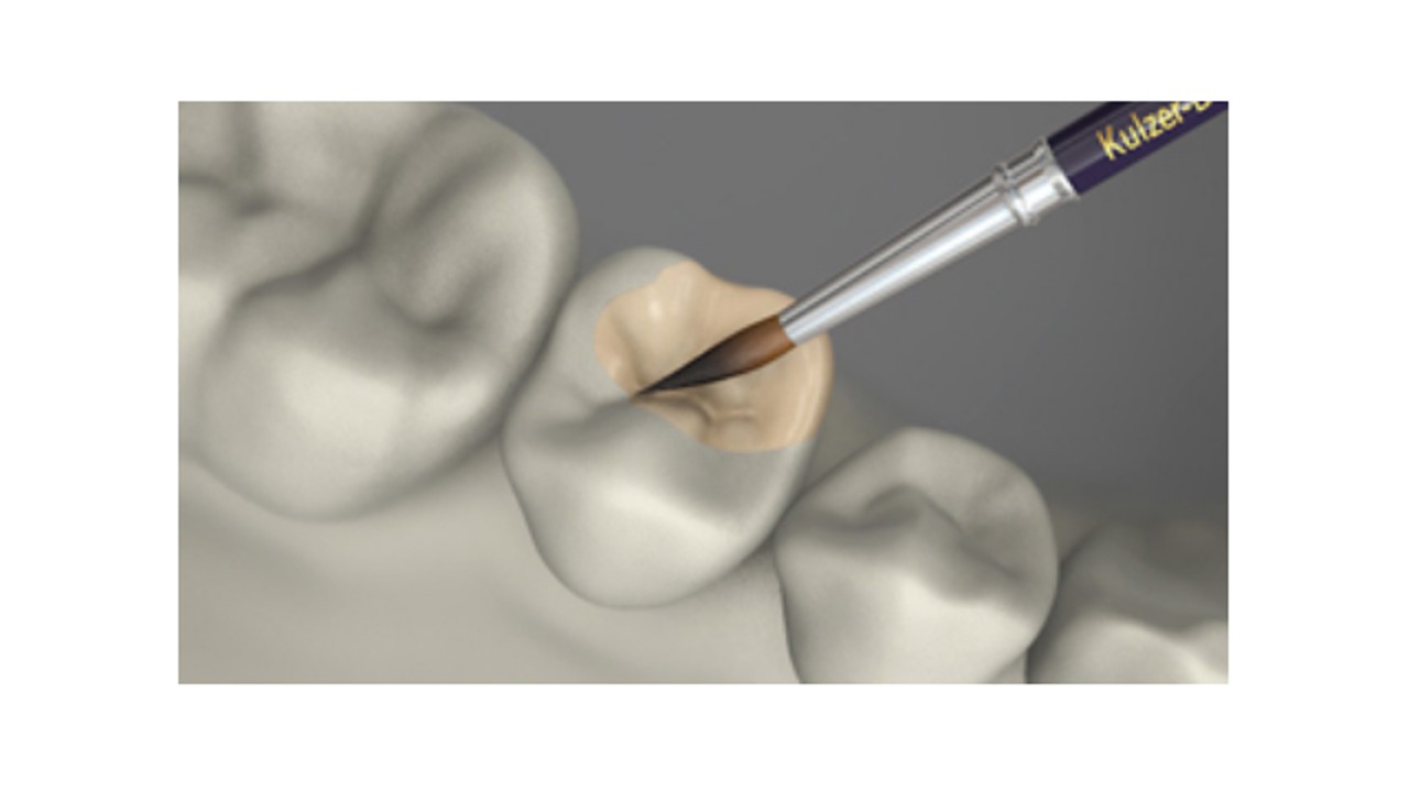 Composites conçus pour les restaurations sans armatures métalliques