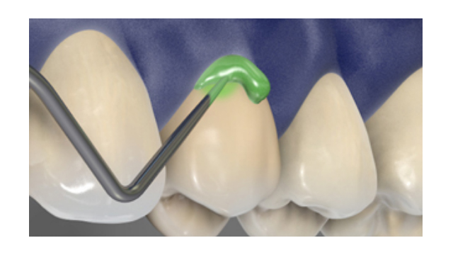 Prophylaxie