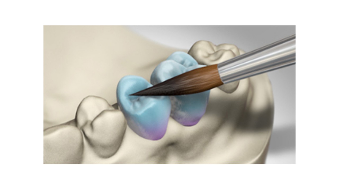 Céramique pour facettes