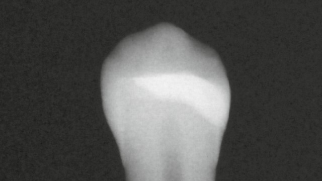 High radiopacity ensuring a reliable diagnosis