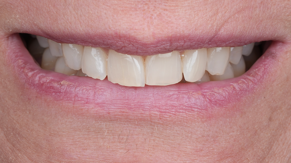 Kulzer Vivida_Case by Dr. Edoardo Fossati, Italy_before