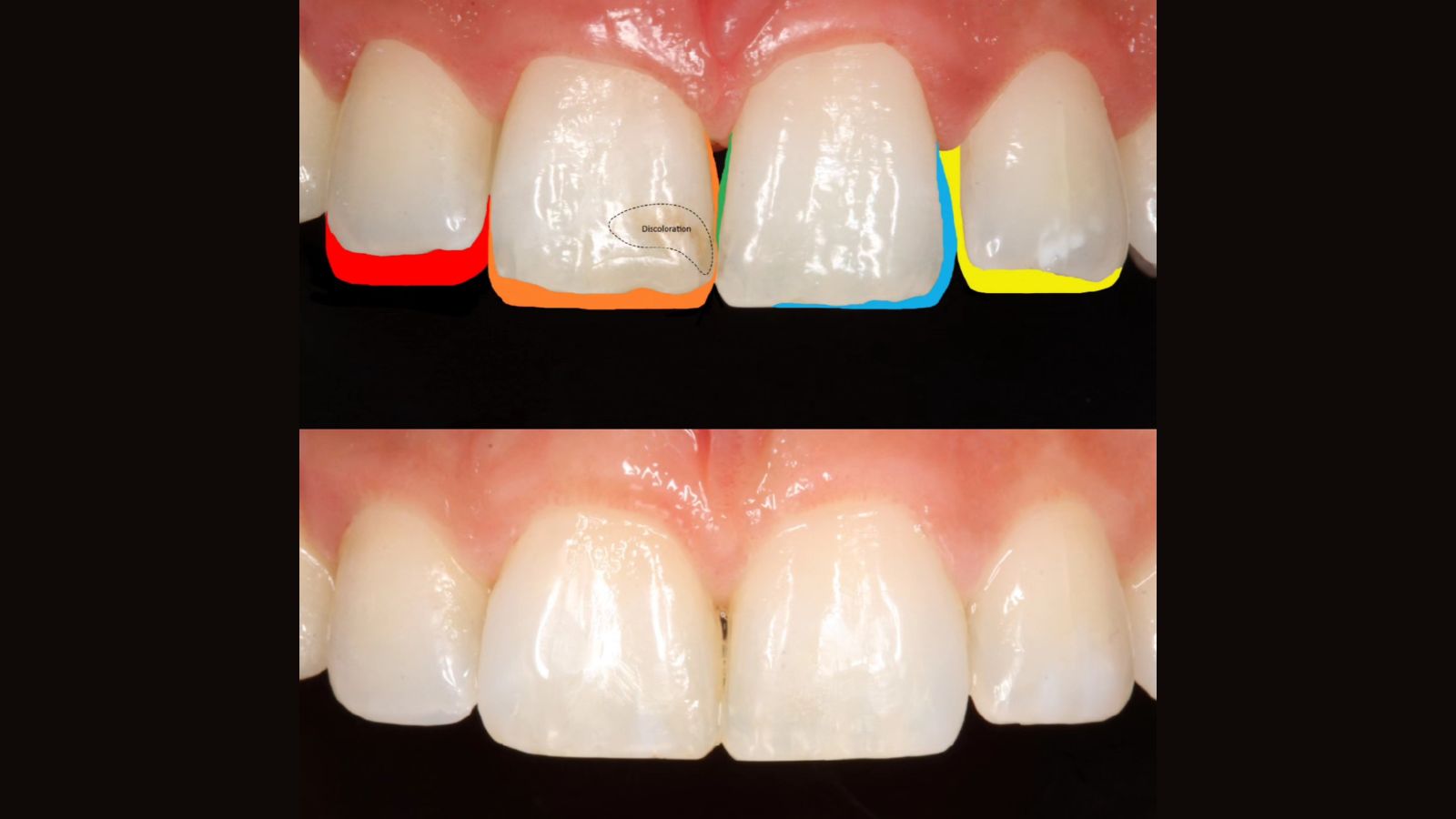 Final monochromatic aesthetic reconstruction of the incisors