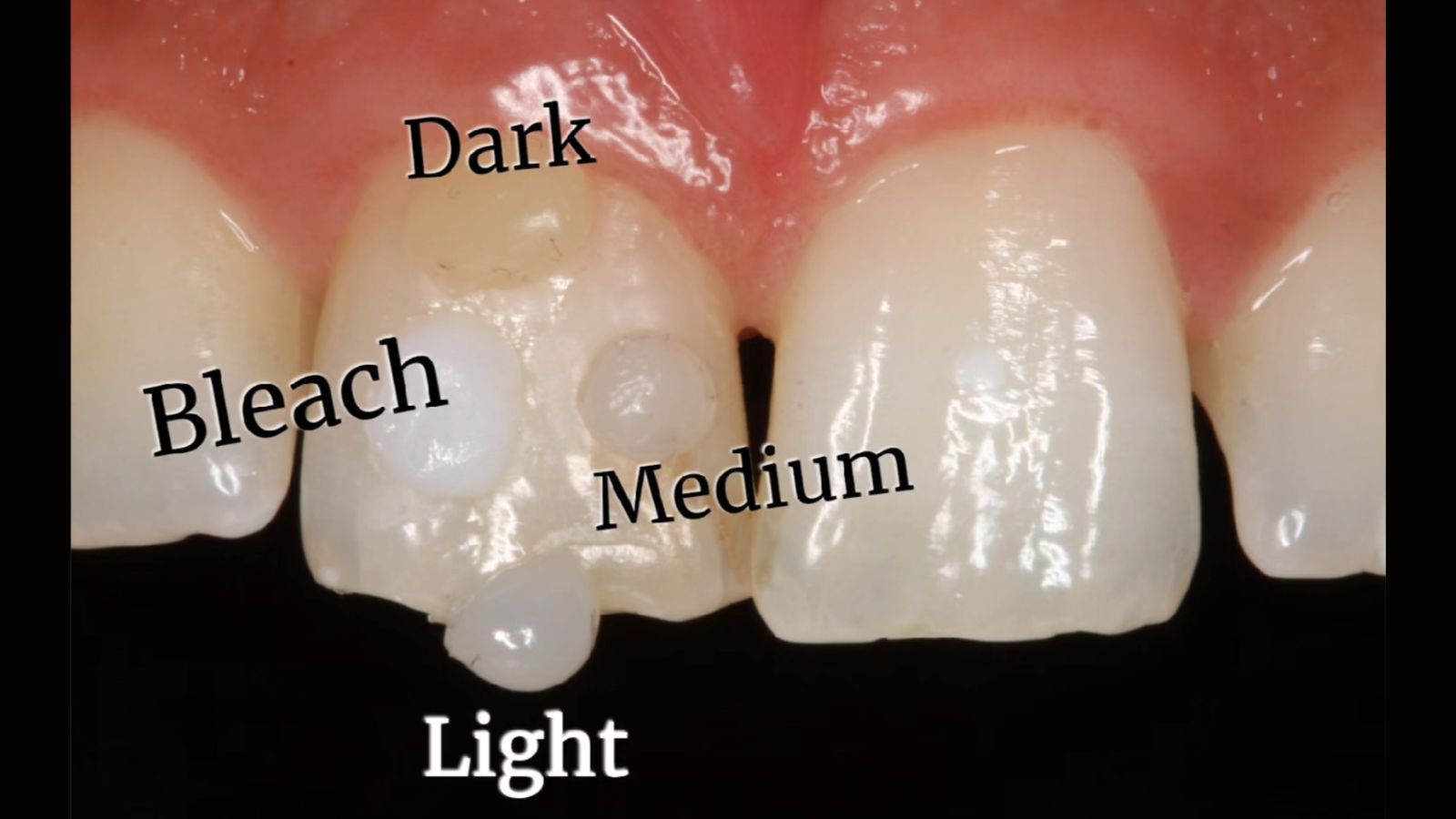 Shade selection with Venus Pearl Pure Shades
