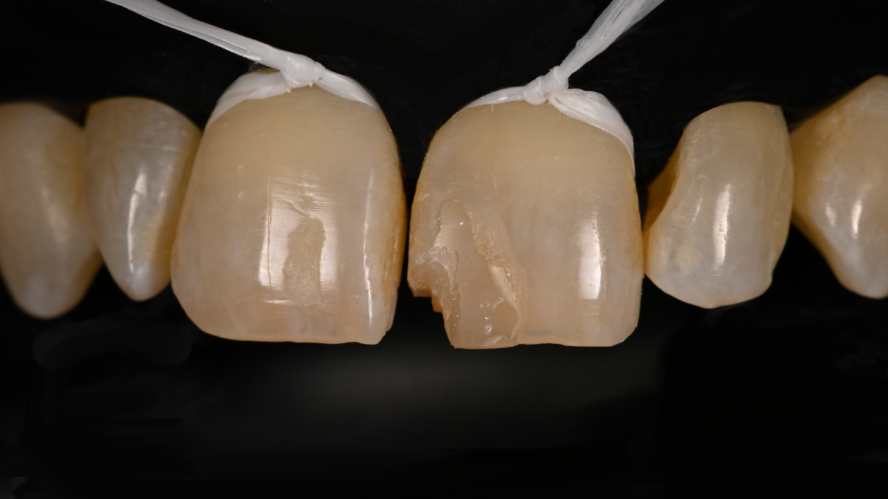 Fracture de la dent 21