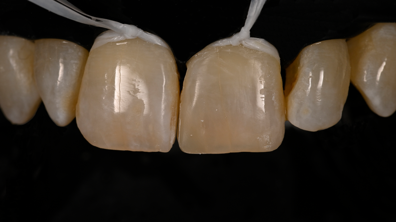 Restauration de la dent 21