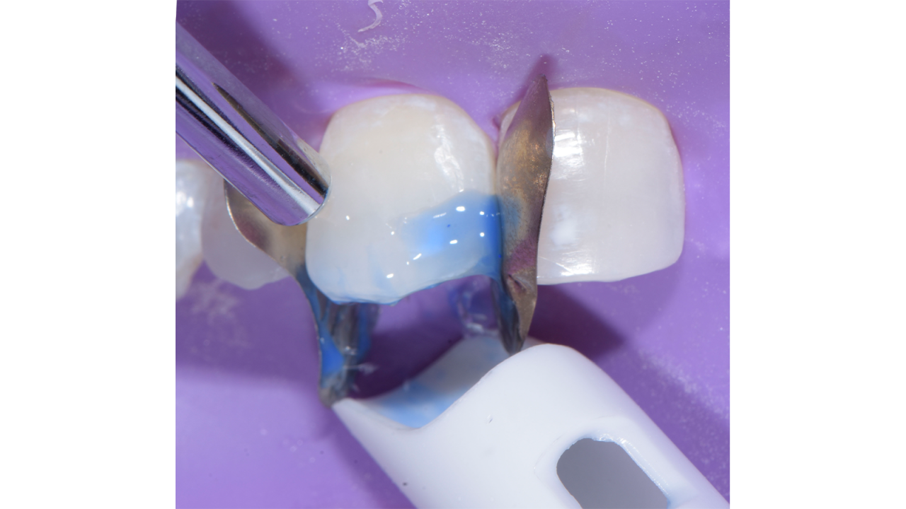 Mordançage de la dent 11 sous isolation