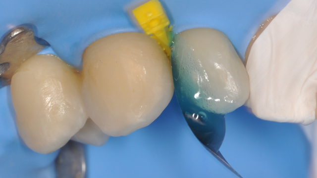 Mordançage avec iBOND Universal