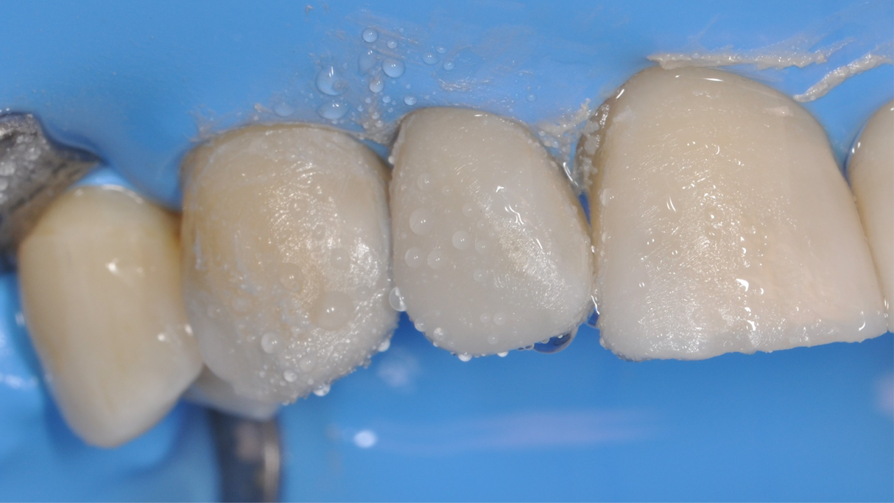 Polissage avec le système de polissage en deux étapes Venus Supra..