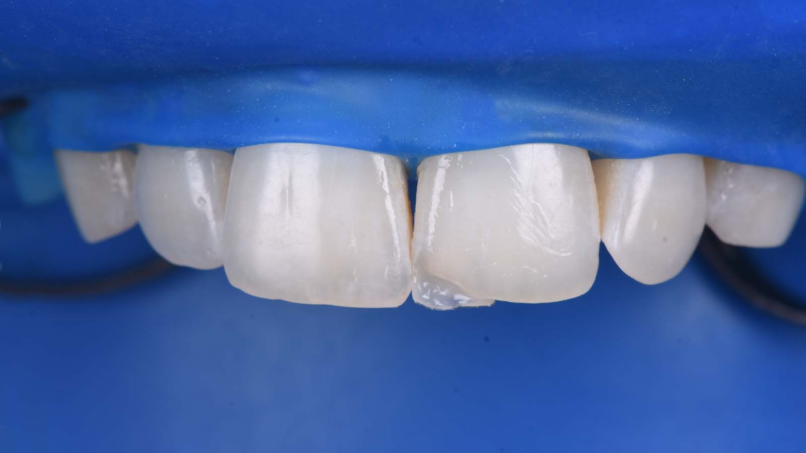 Close-up view of the palatal shell.