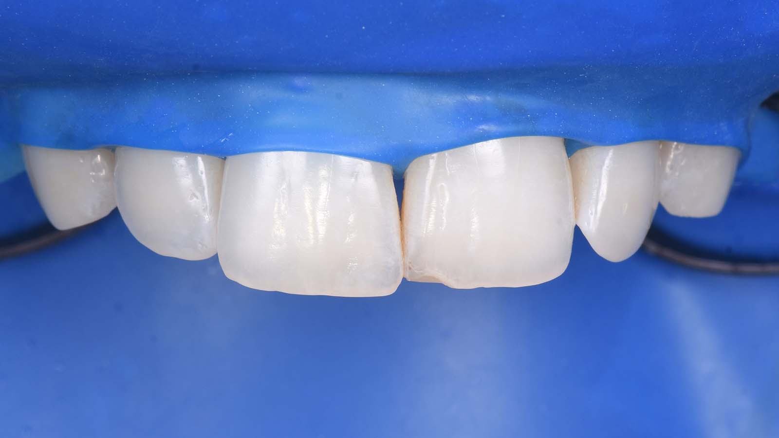 Setting up the operative field with a thick Ivory Rubber Dam.