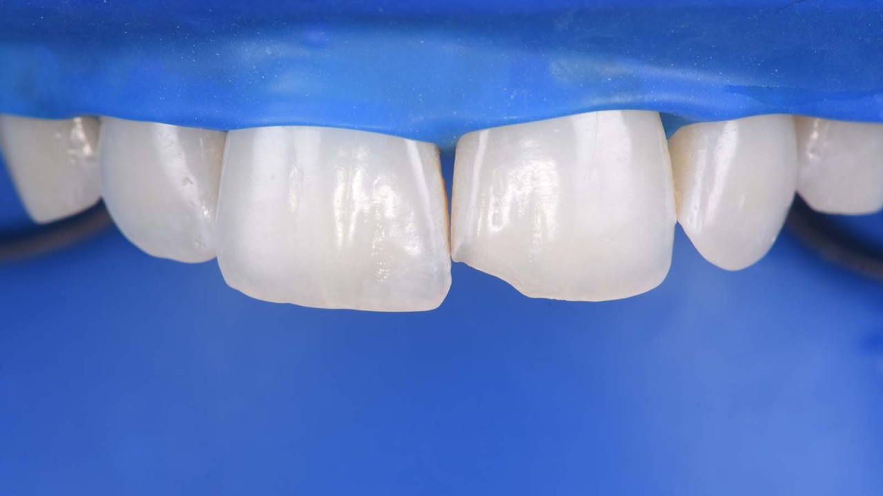 Removal of the old composite