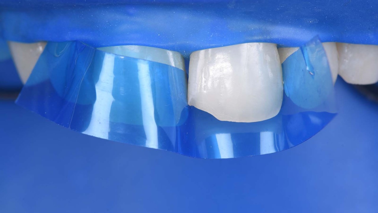 Protecting adjacent teeth