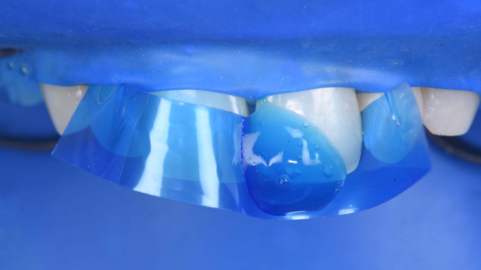Preparing the tooth surface: Etching with iBOND Etch 35 Gel for 20 seconds.